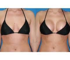 Augmentation des seins par injection de graisse et sans implants ni prothèses prix pas cher. Lipofilling Des Seins Augmentation Mammaire Sans Protheses Softesthetique Tunisie
