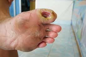 Image result for diabetic toes
