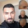 Greffe de cheveux et consultations à paris, bruxelles, nice, luxembourg : 1