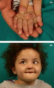 A novel mutation in the SCN9A gene associated with congenital insensitivity  to pain, anhidrosis, and mild cognitive impairment