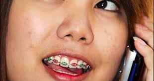 In software development, make is a build automation tool that automatically builds executable programs and libraries from source code by reading files called makefiles which specify. Crackdown On Fake Braces Fashion Fad Cbs News