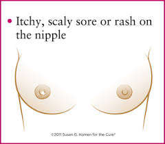 Breast cancer can cause several additional changes to however, people with these symptoms should speak to their doctor in case tests are necessary to check for both noncancerous and cancerous conditions. Eight Warning Signs Susan G Komen New England