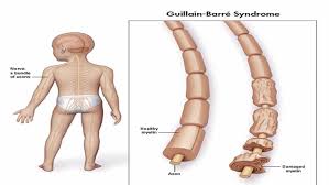 Die erkrankung tritt gehäuft zwischen dem 2. India Xukuru Morre Vitima Da Sindrome Guillain Barre Blog Do Waldiney Passos