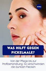 Wie kann man pickelmale entfernen? Der Pickel Ist Verheilt Doch Zuruck Bleibt Ein Kleiner Fleck Wie Ihr Pickelmale Erkennt Und Was Dagegen Hilft Erfahrt Ihr Hier Niv Pickel Haut Hautpflege
