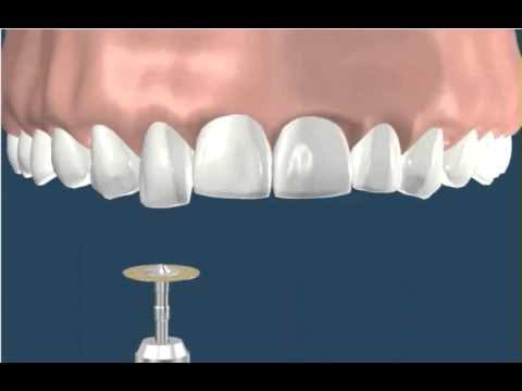 Image result for enamel recontouring"