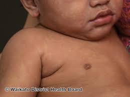 Image result for measles