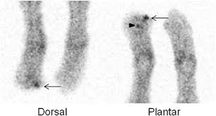 Image result for Osteomyelitis Bone Scan
