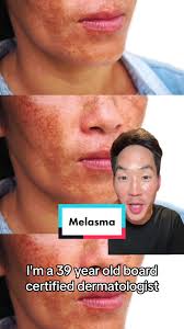 Skincare for Melasma. #dermatologist #dermatology #dermdoctor  #drdavidkimderm #skincare #skincareroutine #skin #melasma #vitaminc #bright  #hyperpigmentation #retinol #tretinoin #tretinoinjourney ...