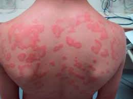 anaphylaxis ile ilgili görsel sonucu