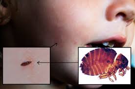 However, fleas can transmit a surprising number of diseases to animals and humans. A Sticktight Flea Removed From The Cheek Of A Two Year Old Boy From Los Angeles