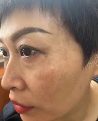 Permission to post admin, makiki daan lang po. Carbon laser for Oily Skin  control or skin pigmentation removal like Melasma and Acne Scars. Book for  your appointment today! @ Roselyn's wellness and