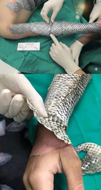Víctima de quemaduras, la piel de tilapia contiene péptidos que ayudan en la  vascularización y reducen la infección, acelerando así la pronta  recuperación. La piel de tilapia es el cuero del pez