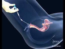 My very first iui cycle (ttc vlog) love channon rosemy book: Intrauterine Insemination Iui Youtube