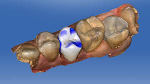 Eine künstliche krone kann aus verschiedenen gründen notwendig sein. Cerec Kronen Ccz Munster