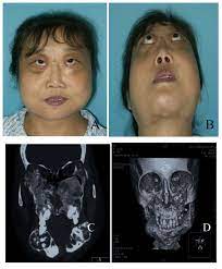 1 cherubism is also referred to as familial fibrous dysplasia affecting the jaws although new genetic investigations tend to indicate that it is a separate entity. A Novel Mutation In The Sh3bp2 Gene Causes Cherubism Case Report Bmc Medical Genetics Full Text