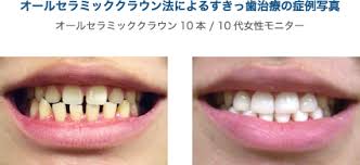 すきっ歯になる原因 少回数で治療できるすきっ歯治療法 ザ ホワイトデンタルクリニック