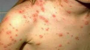 Learn the definition of 'endemic typhus'. æ¬§è·¯è¯å…¸ è‹±æ±‰ æ±‰è‹±è¯å…¸endemic Typhusæ˜¯ä»€ä¹ˆæ„æ€ Endemic Typhusçš„ä¸­æ–‡è§£é‡Šå'Œå'éŸ³ Endemic Typhusçš„ç¿»è¯' Endemic Typhusæ€Žä¹ˆè¯»