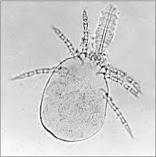 Chiggers do not burrow into the skin, instead they have feeding structures that insert into the skin. Trombiculidae Wikipedia