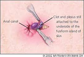 Ongoing pain is especially common for people over age 50. Hemorrhoidectomy For Thrombosed External Hemorrhoids American Family Physician