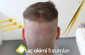 Gold Fue Sac Ekimi Nedir Sac Ekimi Forum