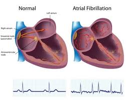 An arrhythmia is an irregular heartbeat due to a disorder of impulse production, impulse conduction, and in some instances, both. Familial Atrial Fibrillation Medlineplus Genetics