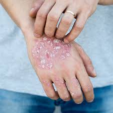 Image result for psoriasis