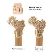 Huftprothese Bei Osteoporose Wirksame Strategien Zur Vermeidung Von Komplikationen Gelenk Klinik De