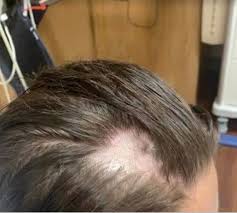 We let it work for fifteen minutes and she rinses the cream off my face and towels me dry. Woman S Hair Fell Out In Clumps After Shampoo Mixed With Hair Removal Cream Mirror Online