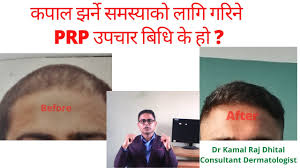 In today's video i answer your questions about hair shedding, thinning hair, brittle hair, and hair care tips! Prp Treatment For Hair Loss In Nepal By Dermatologist Dr Kamal Raj Dhital Hair Transplant In Nepal Youtube