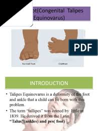 #clubfoot | 12.1m personen haben sich das angeschaut. Club Foot Foot Congenital Disorder