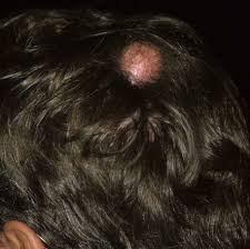 If a sebaceous cyst does not cause problems and its appearance doesn't bother you, you probably don't need any treatment, as mentioned above. Scalp Cyst Medical Pictures Info Health Definitions Photos
