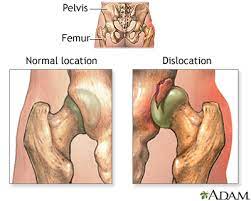 We did not find results for: Dislocation Of The Hip Medlineplus Medical Encyclopedia Image