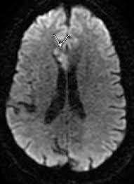 Many symptoms that might make you suspect your cat had a stroke are very similar to the even though these scans can be a bit expensive, this is the best way to pinpoint a condition such as. A Normal Head Ct Scan Does Not Rule Out Ischemic Stroke Part Ii The Stroke Blog