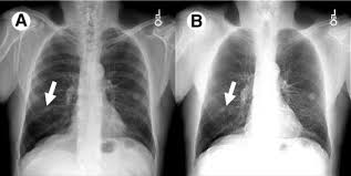 Image result for lung cancer xray