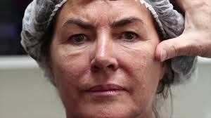 Dr Deutsch Jean-Jacques // Cross Intersection Technique (Threads Lift) //  Français