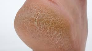 Selalu sakit tumit ketika hamil? Ada Juga Penyelesaian Untuk Tumit Merekah Yang Kronik Kedai Vitamin Butterworth