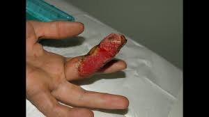 Check spelling or type a new query. Rattlesnake Bite Very Graphic Youtube