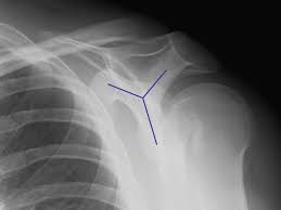Image result for Shoulder History