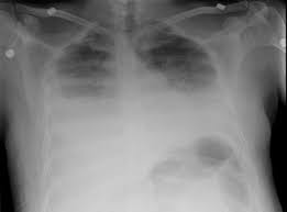 Image result for Atelectasis