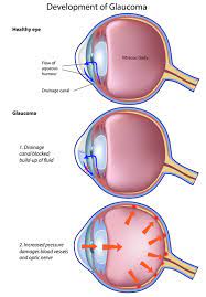 Glaucoma is a group of eye disorders that lead to progressive damage to the optic nerve. Glaucoma Stereo Optical