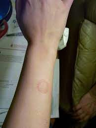 Help For Ringworm Fungal Infections Plus Probiotic Info Ringworm Serious Skin Care Acv For Skin