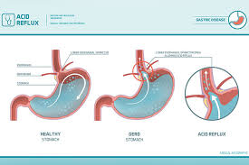 How to get rid of acid reflux naturally. Acid Reflux Gerd In Teens Symptoms Treatment Remedies