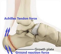 Image result for Calcaneal Apophysitis