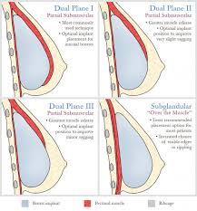 Pin On Breast Augmentation Infographics