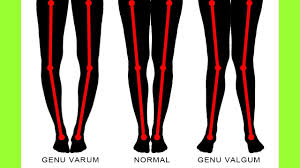 How To Correct Knock Knees In Adults Without Surgery Exercises For Knock Knees Correction Bow Legged Correction Knock Knees Correction Knock Knees