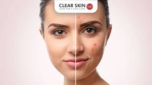 Image result for acne face