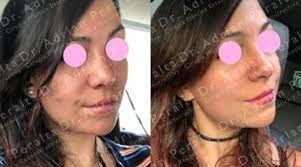 ¿quieres eliminar lo gordo de tus cachetes y tener una cara delgada? Bichectomia Cirujano Plastico Ciudad De Mexico Adrian Peralta