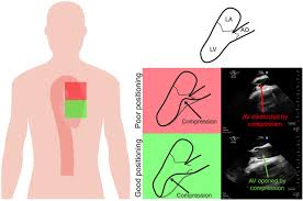Image result for Left Ventricular Outflow Obstruction