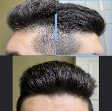 19 Years Old Balding Or Maturing Hairline Hair Beauty Skin Deals Me Fashion Love Cute Style Women Mak Hairline Celebrity Hair Colors Am I Balding