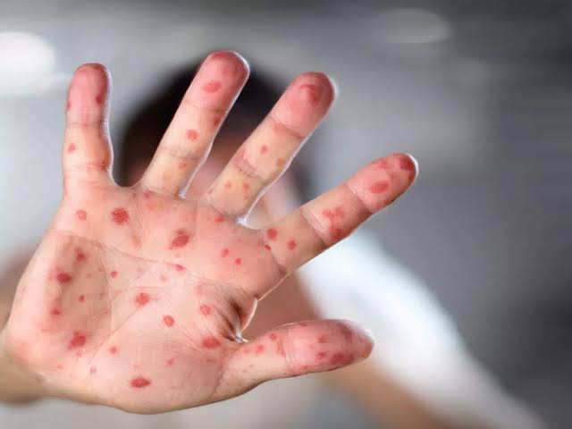 Monkeypox: Which countries have reported cases of the viral disease